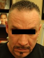 Botox Cosmetic and Dysport