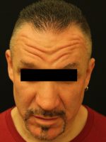 Botox Cosmetic and Dysport