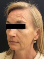 Botox Cosmetic and Dysport