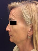 Botox Cosmetic and Dysport