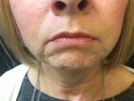 Juvederm