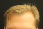 NeoGraft