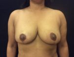 Breast Reduction