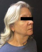 Neck Lift