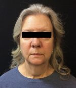 Neck Lift