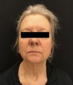 Neck Lift