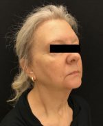 Neck Lift