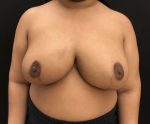 Breast Reduction