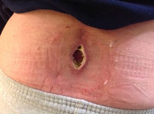 Trunk Reconstruction