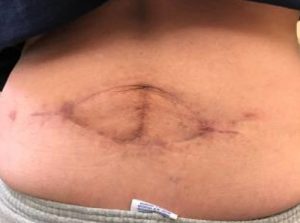 Trunk Reconstruction