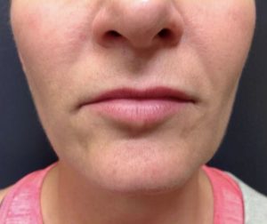 Juvederm
