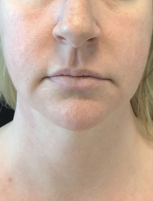 Botox Cosmetic and Dysport