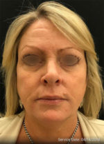 Restylane and Perlane