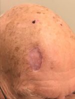 Squamous Cell Carcinoma