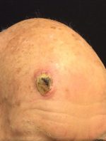 Squamous Cell Carcinoma