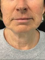 Restylane and Perlane