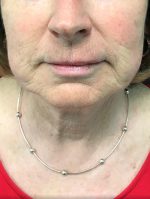 Restylane and Perlane