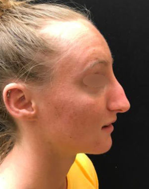 Nasal Reconstruction