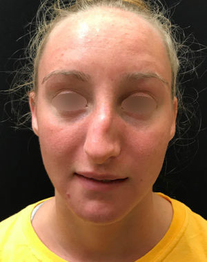 Nasal Reconstruction