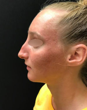 Nasal Reconstruction