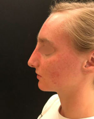 Nasal Reconstruction