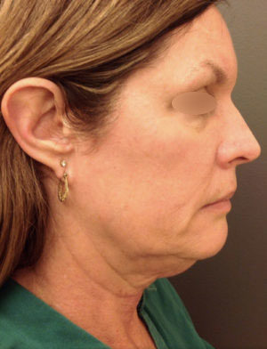 Exilis