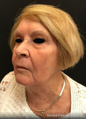 Sculptra