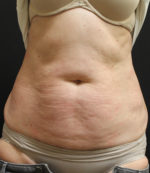 Coolsculpting Before & After Results