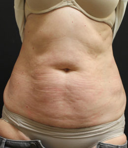 tummy with excess skin, Coolsculpting, Newark NJ Wilmington NC