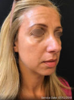 Under Eye Rejuvenation