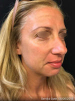 Under Eye Rejuvenation