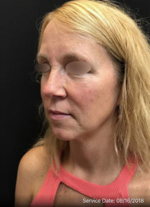 Under Eye Rejuvenation