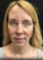 Under Eye Rejuvenation