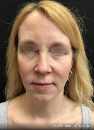 Under Eye Rejuvenation