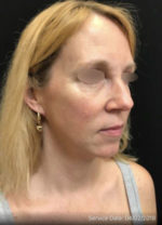 Under Eye Rejuvenation