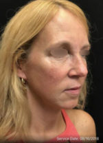 Under Eye Rejuvenation