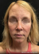 Under Eye Rejuvenation