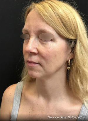 Under Eye Rejuvenation
