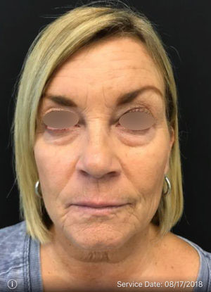 Under Eye Rejuvenation