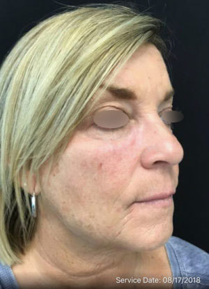 Under Eye Rejuvenation