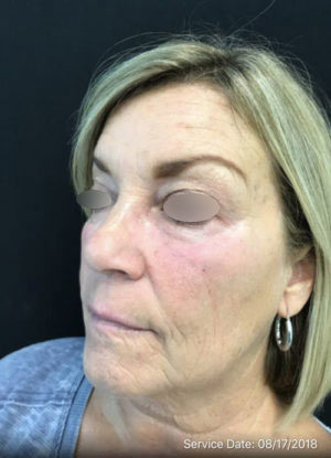 Under Eye Rejuvenation