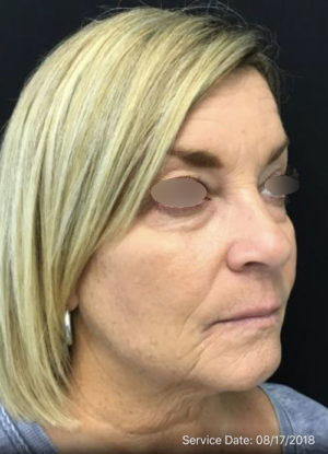 Under Eye Rejuvenation
