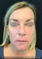 Under Eye Rejuvenation