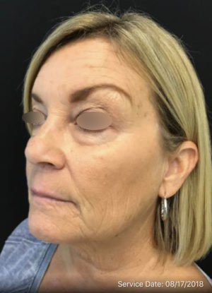 Under Eye Rejuvenation