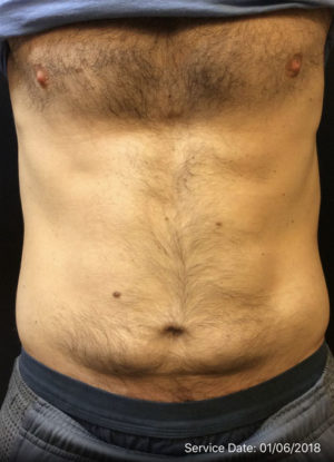 Mini Tummy Tuck