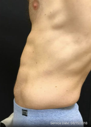 Mini Tummy Tuck