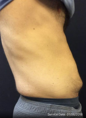 Mini Tummy Tuck