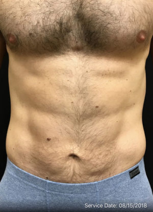 Mini Tummy Tuck