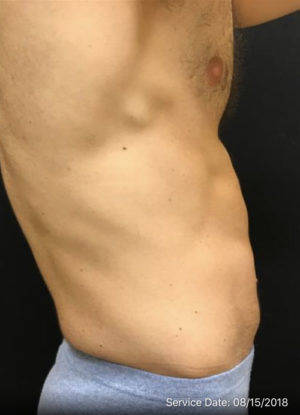 Mini Tummy Tuck