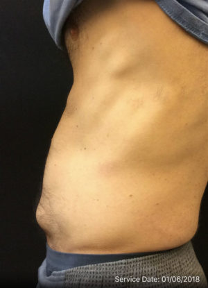 Mini Tummy Tuck